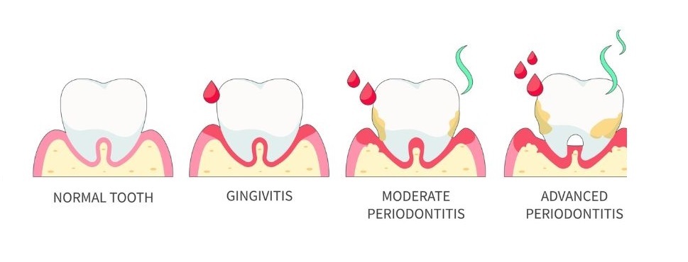 Verschillende fases van tandvleesaandoening parodontitis.