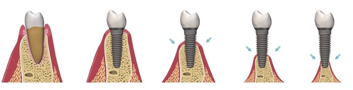 Implantaten in de mond met verschillende fases.